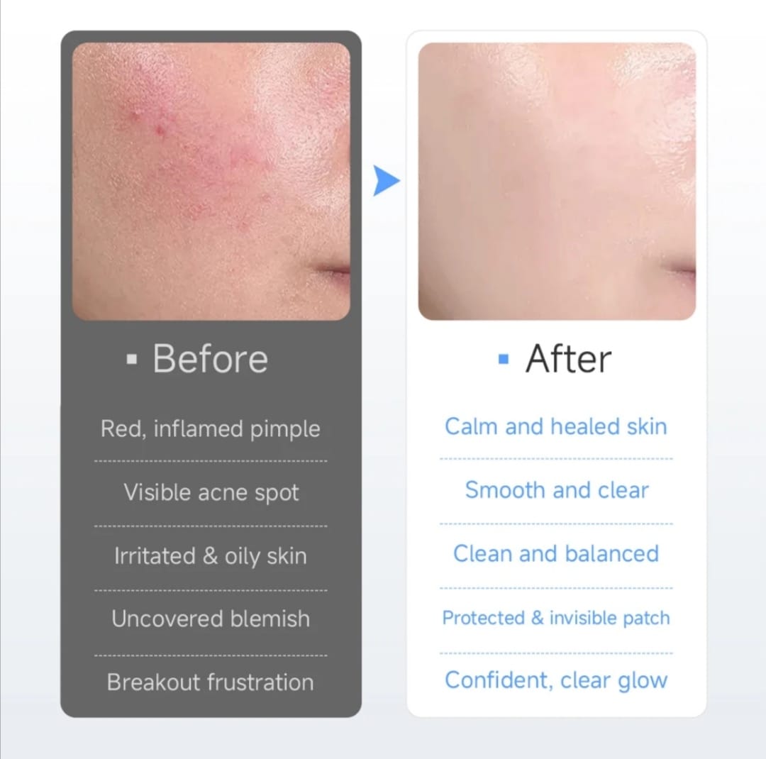 ACNE PATCH WITH ESSENTIAL OILS