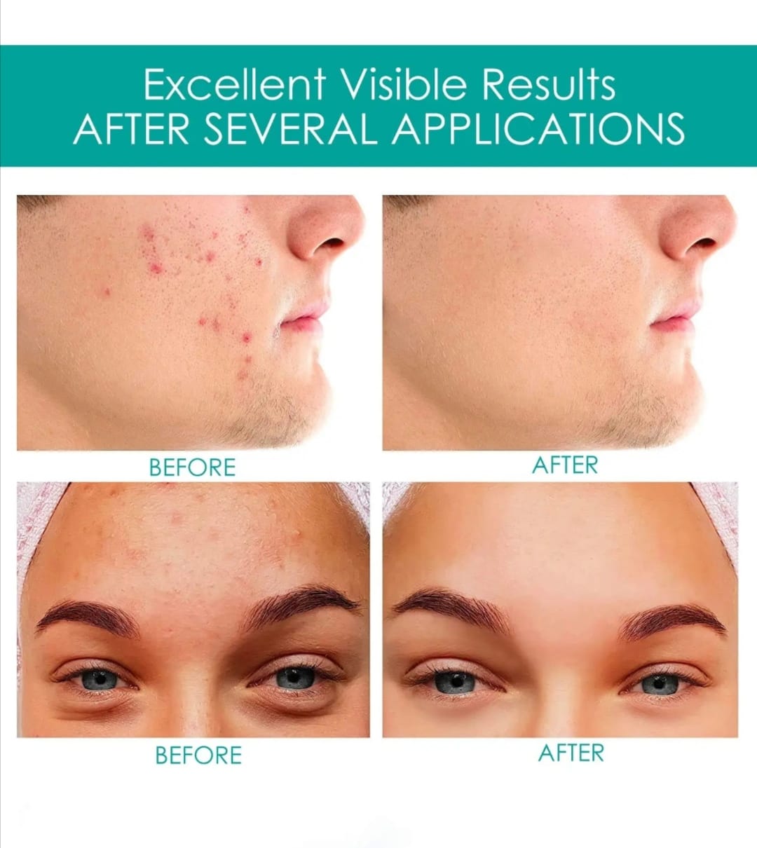 ACNE PATCH WITH ESSENTIAL OILS